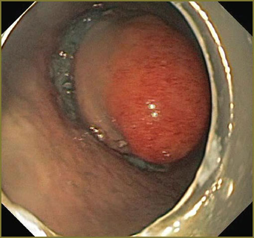 kantsevoy-fig-2.jpg