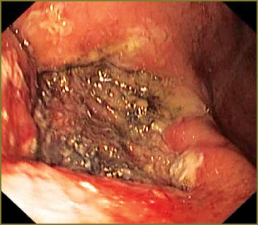 kantsevoy-fig-3.jpg