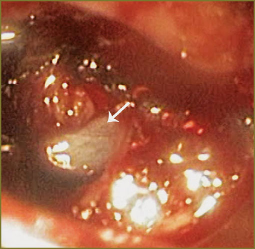 kantsevoy-fig-4.jpg